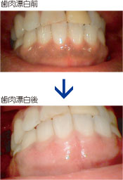 歯肉漂白(ガムピーリング)
